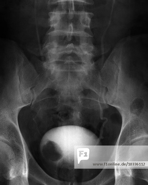 Röntgenbild eines ca. drei Zentimeter großen Rohrkolbentumors