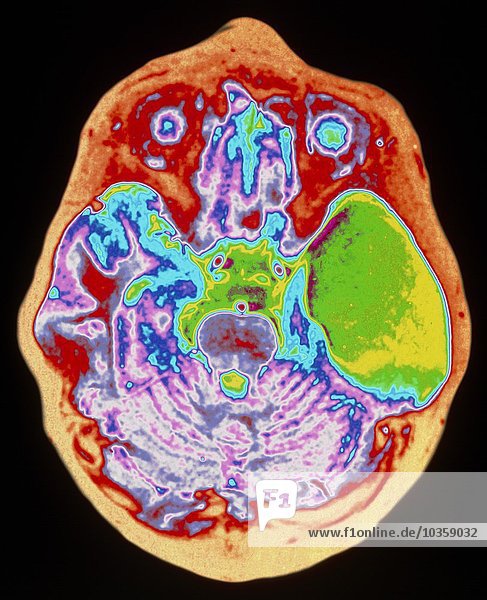 Farbige MRT-Aufnahme des Gehirns mit Darstellung einer Arachnoidalzyste