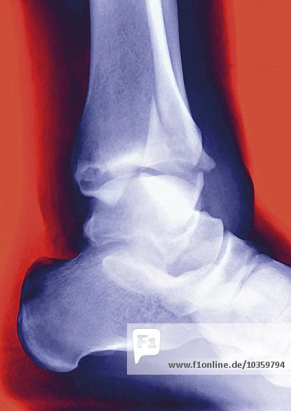 Gebrochener Knöchel  Röntgenbild