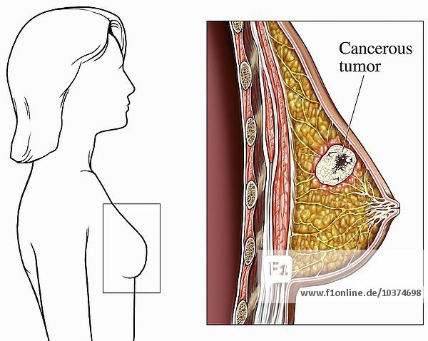 Biomedizinische Illustration eines krebsartigen menschlichen Brusttumors. Die erste Grafik zeigt die weibliche Brust in der vergrößerten Darstellung  die den Tumor identifiziert und illustriert.