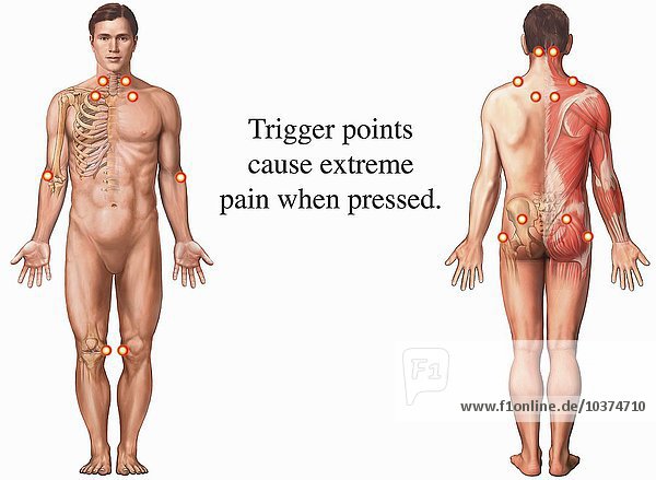 Biomedizinische Illustration  die die Triggerpunkte im Zusammenhang mit dem Fibromyalgie-Syndrom (FMS) oder dem myofaszialen Schmerzsyndrom zeigt. Die Druckpunkte sind angedeutet und auf der Vorder- (Vorderseite) und Rückseite (Rückseite) der männlichen Figur zu sehen.