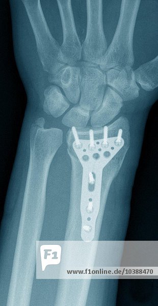 Röntgenaufnahme einer chirurgischen Praxis. Das Röntgenbild zeigt : Seitliches Sprunggelenk