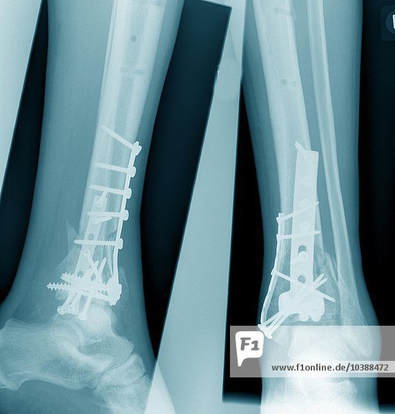Röntgenaufnahme aus einer chirurgischen Praxis. Das Röntgenbild zeigt: Tibiafraktur mit Verplattung.