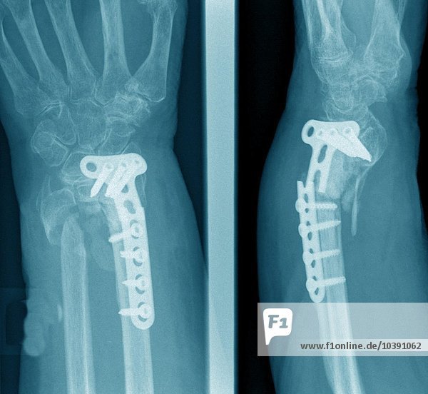 Röntgenaufnahmen einer chirurgischen Praxis. Unterarmbruch |