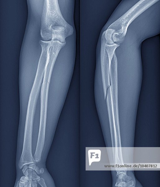 Gebrochener Arm  Röntgenbild