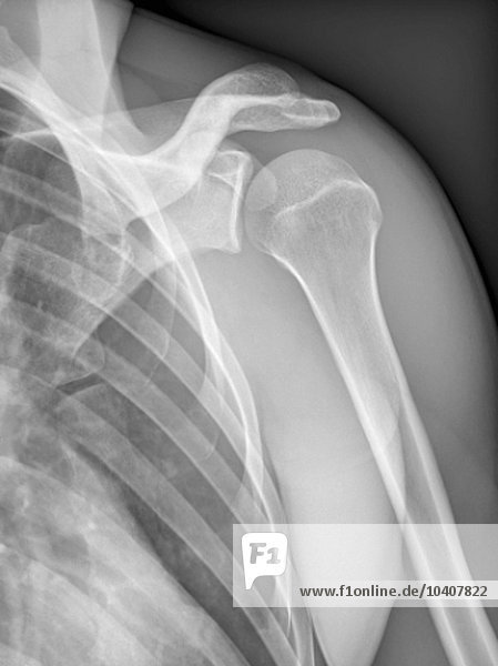 Normale Schulter  Röntgenbild