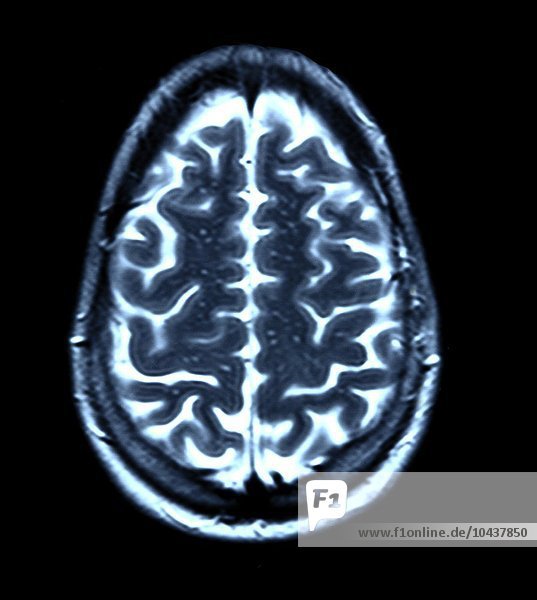Normales Gehirn. Farbige Magnetresonanztomographie (MRT) eines axialen Schnitts durch ein gesundes Gehirn. Die Vorderseite des Gehirns befindet sich im oberen Teil des Bildes. Hier sieht man das Großhirn  den größten Teil des Gehirns. Es ist in zwei Gehirnhälften unterteilt und für bewusstes Denken  Emotionen und willkürliche Bewegungen verantwortlich. Gehirnscan  MRT-Scan
