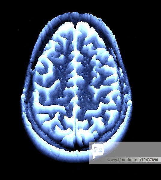 Normales Gehirn. Farbige Magnetresonanztomographie (MRT) eines axialen Schnitts durch ein gesundes Gehirn  umgerechnet in eine Höhenkarte oder ein Höhenfeld. Die Vorderseite des Gehirns befindet sich im oberen Teil des Bildes. Hier sieht man das Großhirn  den größten Teil des Gehirns. Es ist in zwei Gehirnhälften unterteilt und für bewusstes Denken  Emotionen und willkürliche Bewegungen verantwortlich. Gehirnscan  MRI-Scan  Höhenkarte