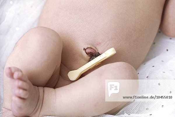 Nabelschnurclip bei einem 4 Tage alten Baby Nabelschnurclip