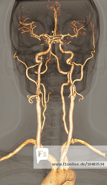 Normale Arterien. 3D-Computertomographie (CT) der hirnversorgenden Arterien eines 38-Jährigen  normale Arterien  3D-CT-Scan
