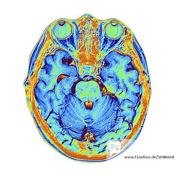 Gehirn-Scan. Falschfarben-Magnetresonanztomographie (MRT) eines menschlichen Kopfes mit einem gesunden Gehirn in horizontaler Ansicht. Im oberen Rahmen sind die beiden Augäpfel zu sehen. Zwischen den Augen befindet sich die Nasenhöhle mit den Nasenmuscheln  dünnen  spiralförmigen Knochen. Das MRT-Scannen ist eine Diagnosetechnik  bei der ein starker Elektromagnet und Radiowellen Querschnittsbilder von Körperregionen erzeugen. Farbiger MRT-Scan des menschlichen Kopfes
