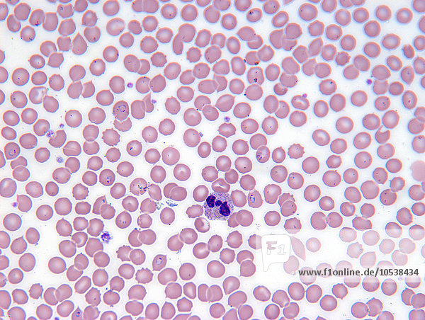 Malaria-Blutzellen