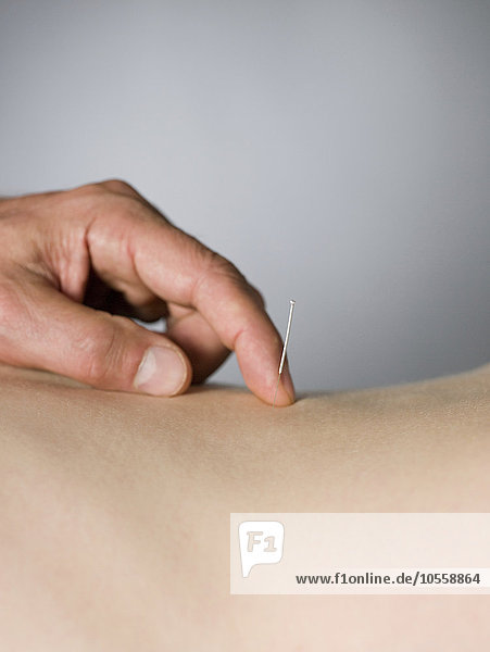 Nahaufnahme eines Akupunkteurs  der die Nadel im Rücken eines Patienten überprüft
