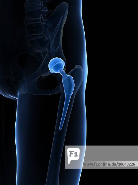 Human hip replacement artwork