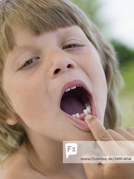 Boy showing missing tooth