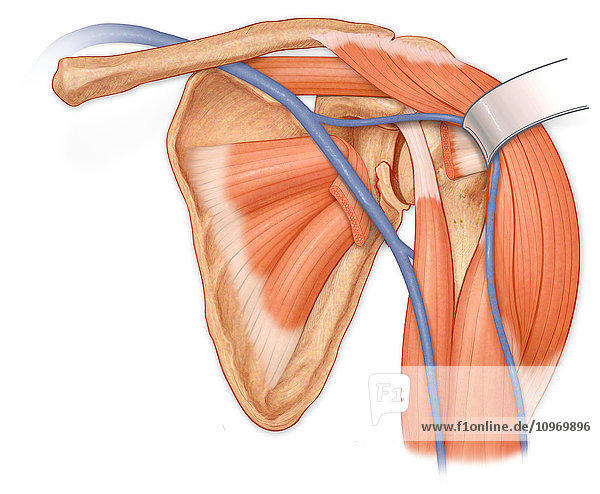 Anterior view of the shoulder joint  hilighting reflected deltoid to show torn subscapularis muscle and fractured infraglenoid tubercle  also showing supraspinatus  subscapularis and biceps muscles