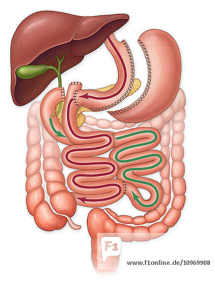 Bilio pancreatic diversion surgery and abdominal organs