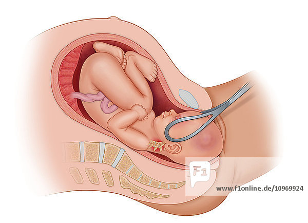 Cross section of the mother's anatomy showing the baby OP in uteruo being delivered by forceps  turning baby's head from Rop to OP. Because the baby is in the incorrect position for delivery  the baby's neck is being pulled in the wrong direction causing neurologic injury  and the spinal cord is being stretched.