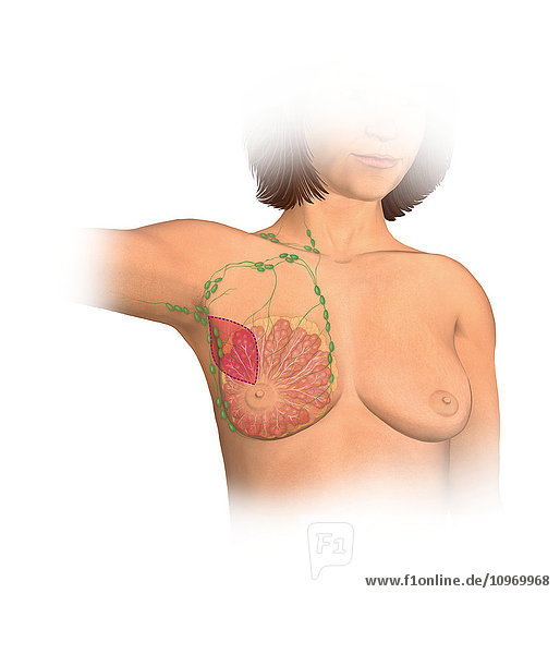 Anterior view female anatomy showing breast tissue and muscle affected by a partial mastectomy