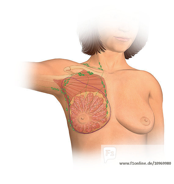 Anterior view female anatomy showing breast tissue and muscle affected by a radical mastectomy