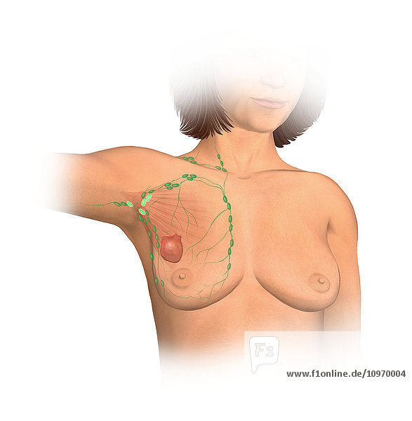 Anterior view female anatomy showing breast tissue with a tumor  stage three breast cancer