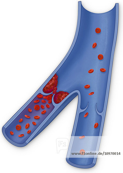Deep vein thrombus