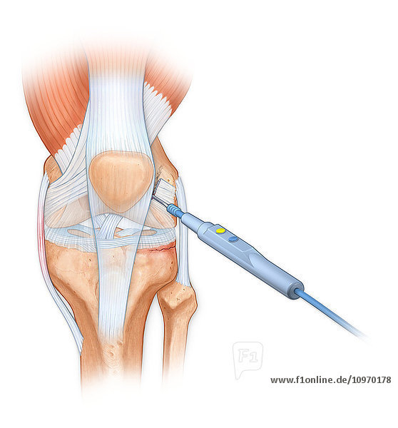 Bovie used to cut through retincaculum  and clean up femur of Displaced patellar knee bone