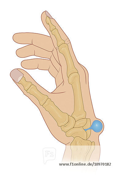 Illustration of dorsal wrist Ganglion cyst