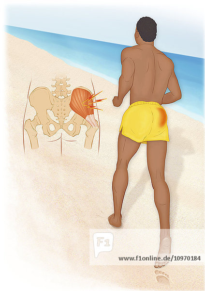 Gluteus medius syndrome usually is caused by a repetitive motion to a muscle during activities like running on a soft surface  overuse of exercise equipment and any repetitive activities that require hip extension