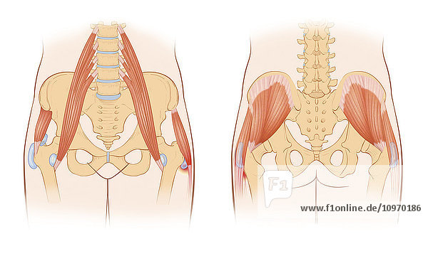 Snapping hip syndrome occurs when the iliopsoas tendon subluxes over the greater trochanter or iliopectinate eminence. Frequently found with people with arthritis of the hip