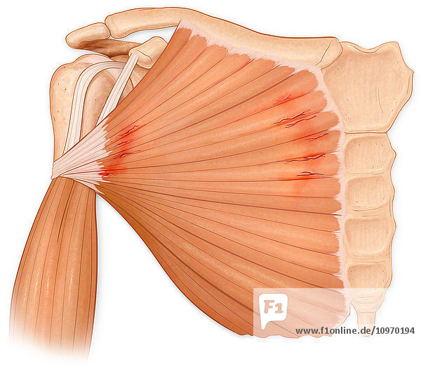 Microscopic muscle fiber tears of the pectoralis major muscle  also called Pectoralis Major Tear Syndrome