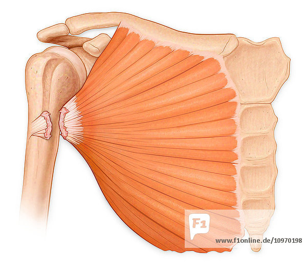 Complete rupture of the pectoralis major tendon from the humerus  due to pectoralis major tear syndrome