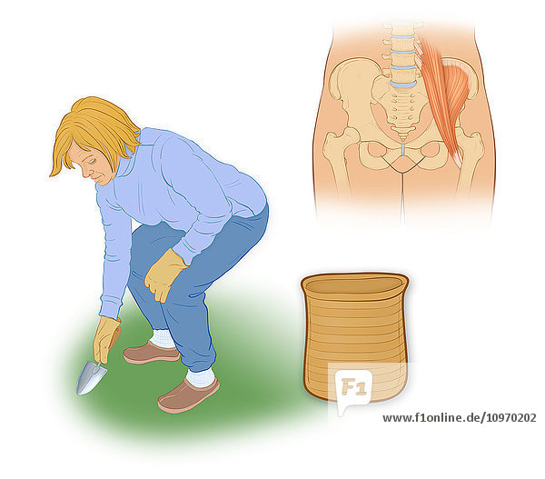 Snapping hip syndrome is the result of the iliopsoas tendon subluxing over the greater trochanter or ilopectineal eminence. The symptoms most commonly occur when rising from a sitting to a standing position or walking briskly.