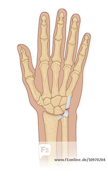 Hand bones with injury