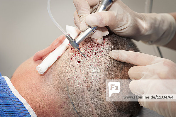 Reportage in the Mozart plastic surgery clinic in Nice  France. FUE (Follicular Unit Extraction) hair transplant on a patient who has already undergone two strip harvesting sessions which have left scars. FUE will avoid this. FUE involves harvesting individual follicular units using a hollow needle that is 0.9-1.2mm in diameter  and reimplanting them in the bald patch. Harvesting.