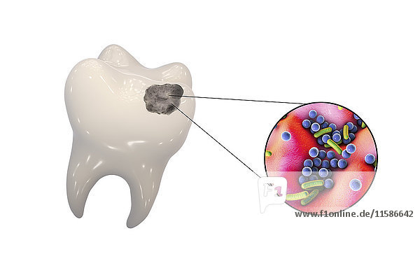 Tooth decay. Computer illustration of a tooth with a cavity and a close-up view of the bacteria that cause caries formation.