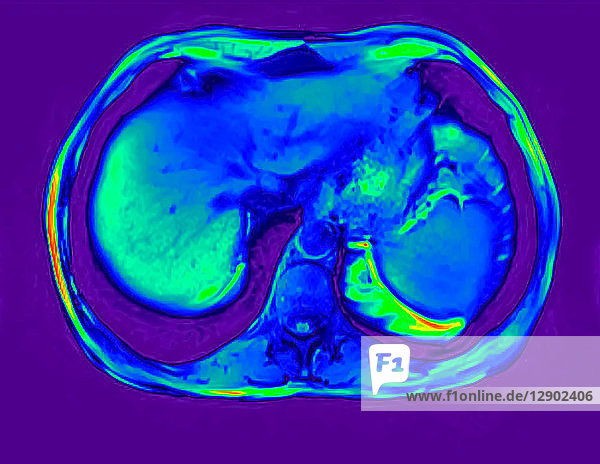 Querschnitt-Abdomen-MRT-Scan eines 60-jährigen männlichen Patienten mit Nierenstein