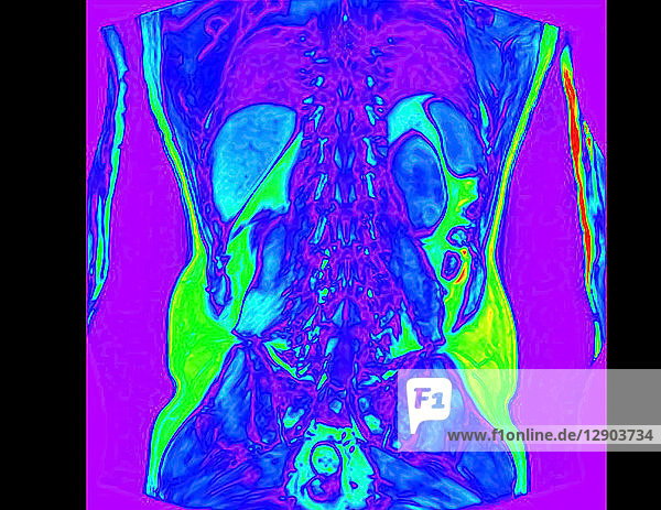 MRT-Untersuchung des frontalen Abdomens eines 60-jährigen männlichen Patienten mit Nierenstein