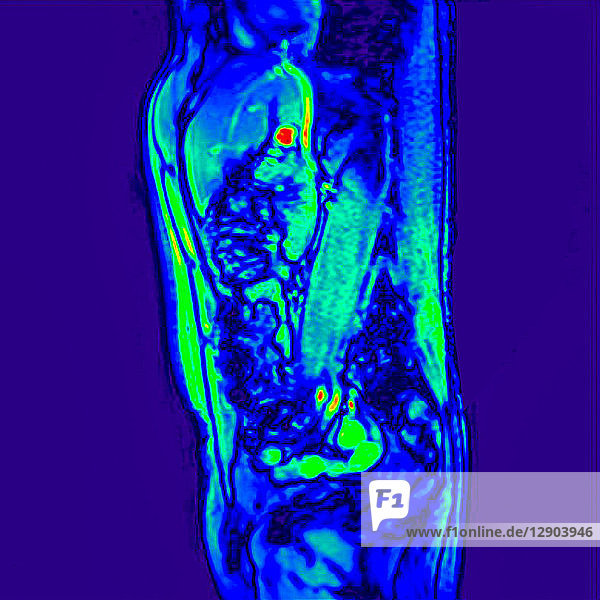 Seitenansicht Abdomen-MRT-Scan eines 60-jährigen männlichen Patienten mit Nierenstein