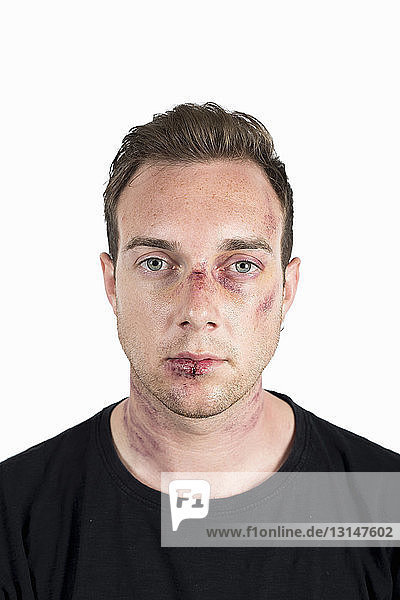 Porträt eines jungen männlichen Opfers häuslicher Gewalt mit verletztem Gesicht