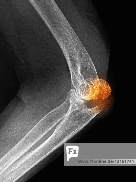 Röntgenbild einer Olekranonfraktur