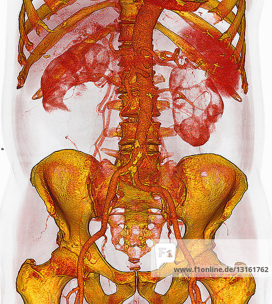 3D-CT-Scan der atherosklerotischen Plaque  untere Aorta