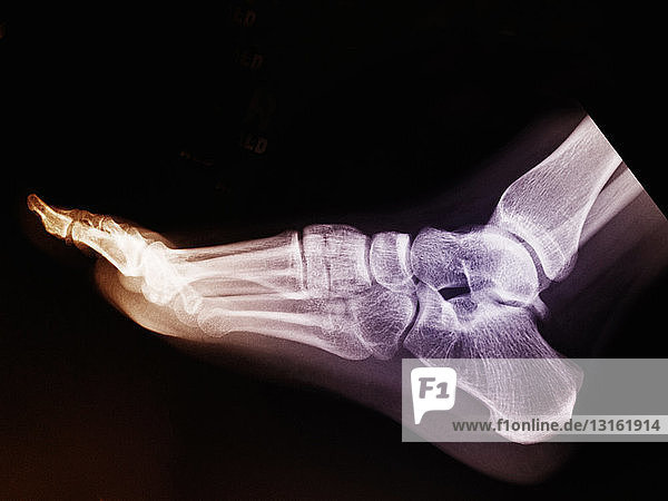 normal foot x-ray of a 17 year old woman