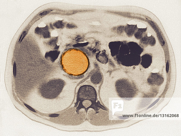 Pancreatic pseudocyst seen on MRI