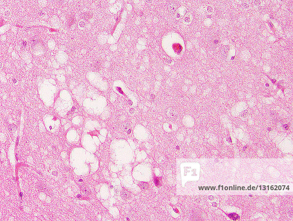 Prion disease  spongiform encephalopathy