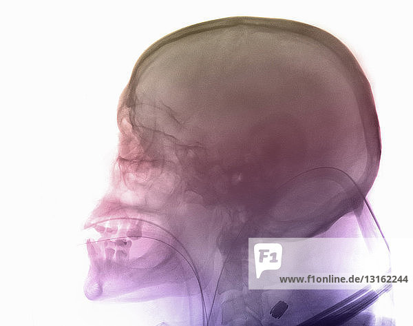 Schädel-Röntgenaufnahme eines Mannes bei einem Motorradunfall