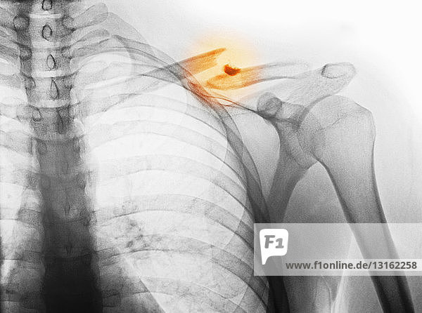 x-ray showing fractured clavicle