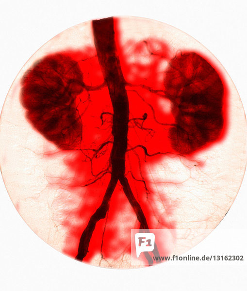 Kidney arteriogram of normal kidneys