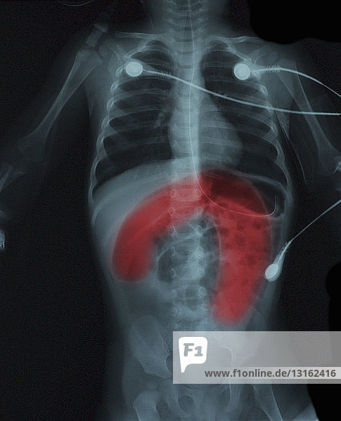 Röntgenbild zeigt Hirschsprunge