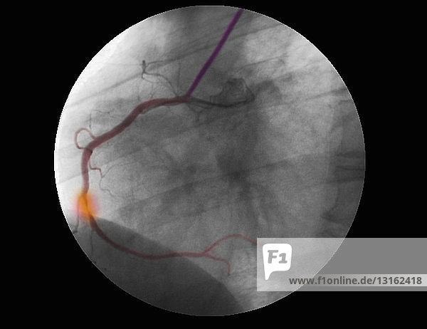 Angiogramm der RCA mit Stenose und Reparatur